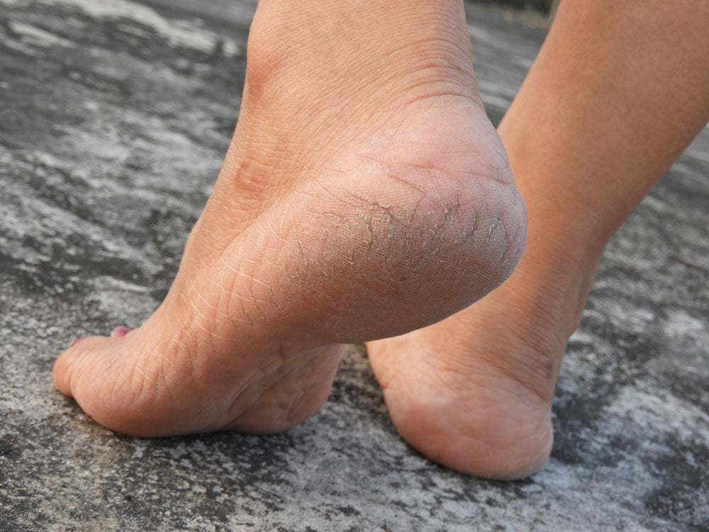 How do you remove dead skin from your feet?