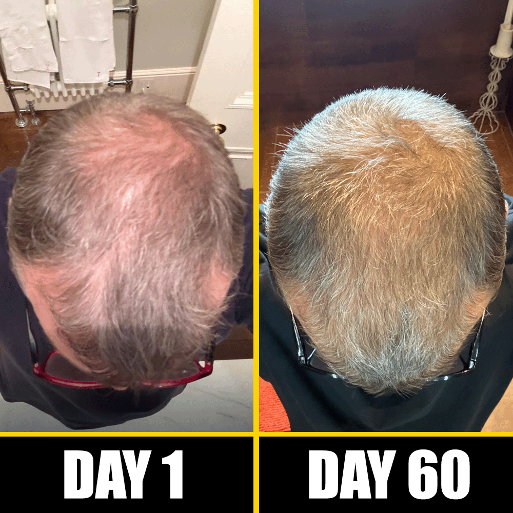 is ghk cu a dht blocker ghk cu serum vs injection GHK- Cu Copper Tripeptide Hair Serum: DHT Blocker, Fuller Looking Hair Soon as 7-9 Weeks is ghk cu a dht blocker ghk cu serum vs injection GHK- Cu Copper Tripeptide Hair Serum: DHT Blocker, Fuller Looking Hair Soon as 7-9 Weeks