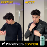 mens dandruff hair before and after with coal tar anti-dandruff shampoo